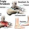arthrodesis