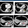 bronhopulmonalna_sekvestraciq