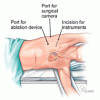 Минимално-инвазивните тазобедрени ендопротези, тазобедрени ендопротези, изкуствена тазобедрена става, минимално-инвазивната техника, минимално-инвазивни операции усложнения