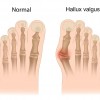 hallux-valgus-1280px-1024px0