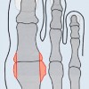 Hallux_Rigidus180