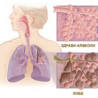 Вродено свръхраздуване на белия дроб, медиастинално притискане и респираторен дистрес, вътрешна или външна бронхиална обструкция, тахипнея ретракция на гръдната стена и свиркащо ди­шане след раждането, Аускултаторно в засегнатата половина дишането е отслабе­но при хиперрезонанс, хипераерация на увредения лоб с ателектаза на околните сегменти, хро­ничната баротравма
