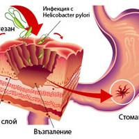 jazva-gastrit