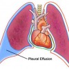 malignant_pleural_effusion
