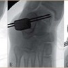 Лечение на деформираща артроза,Терапия на Osteochondrosis dissecans tali, дебридман на хрущялната част, размекване на хрущяла, Дисекиран фрагмент in situ, лечение на артроза, заболяване на костите