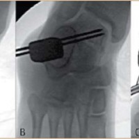 Лечение на деформираща артроза,Терапия на Osteochondrosis dissecans tali, дебридман на хрущялната част, размекване на хрущяла, Дисекиран фрагмент in situ, лечение на артроза, заболяване на костите