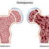 osteoporosiss