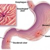 Peptic-ulcers-lg-enlg