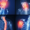 Лечение на Polymyalgia rheumatica, гигантоклетъчен артериит, кортикостероиди и гигантоклетъчен артериит, проява на разширени вени , какво е Polymyalgia rheumatica, Polymyalgia rheumatica лечение, Polymyalgia rheumatica prednisolon,