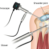 Shoulder-Arthroscopy