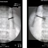 vertebrodesis