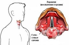 рак на гърлото, рак на ларинкса, рак на бял дроб, рак на трахея, рак в гърлото, тумори на ларинкса, ларинкс рак, рак на гърлото лечение