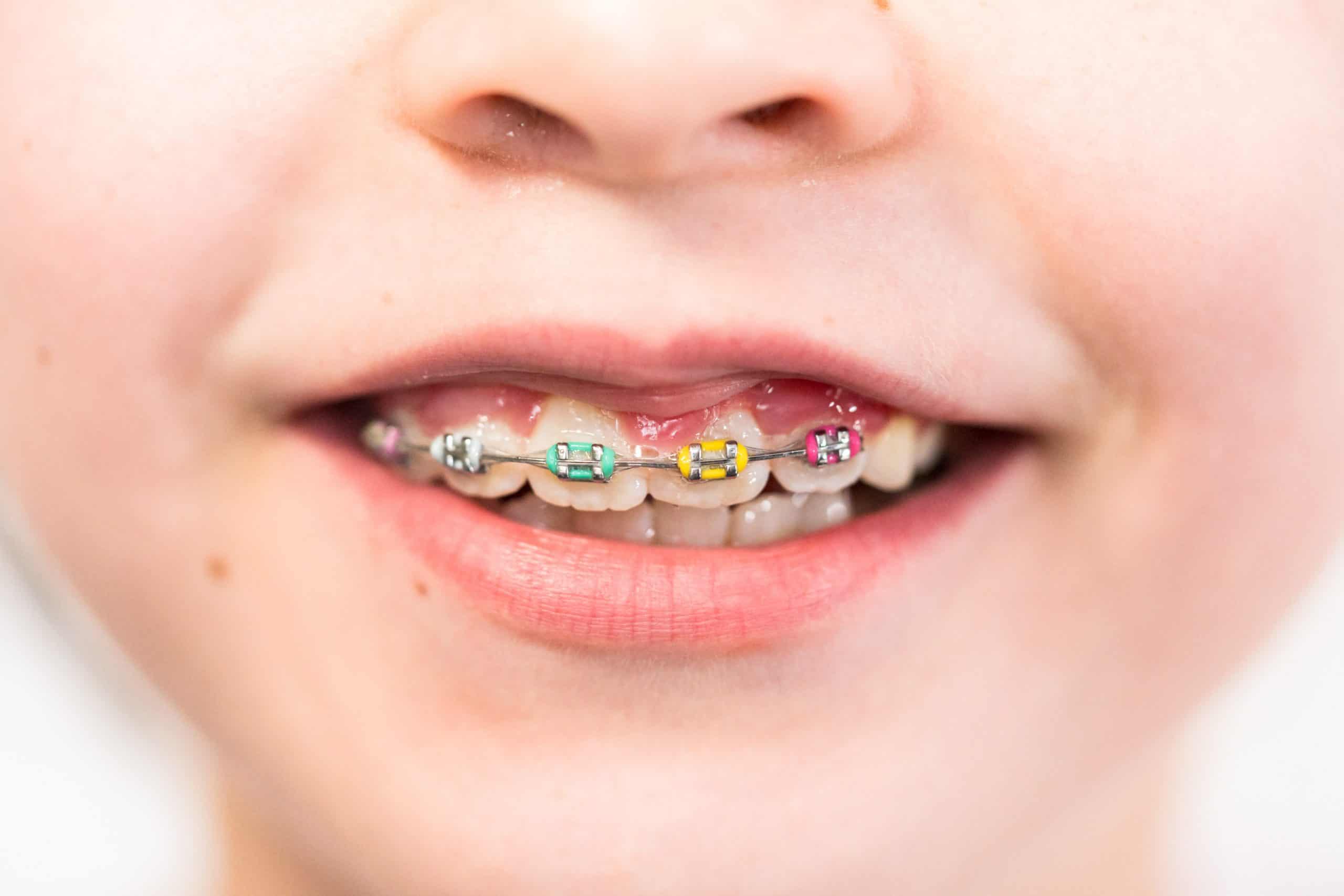 Braces-Colors-scaled