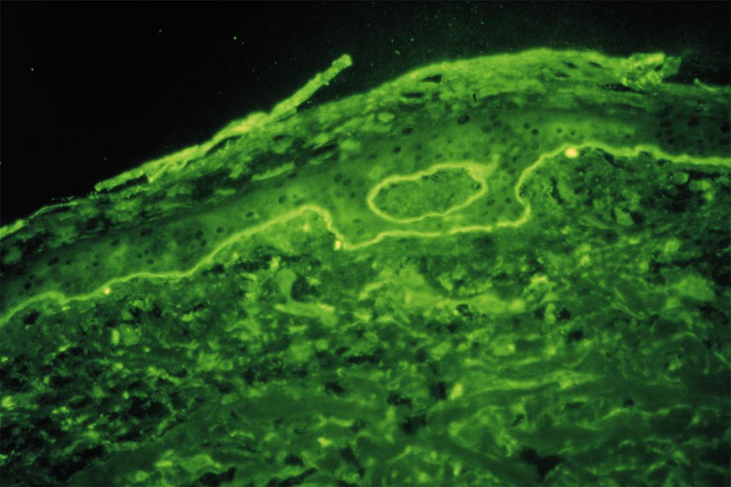 Bullous_pemphigoid1