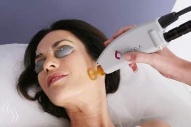 Face-Laser-Hair-Removal