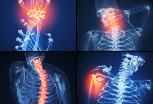 Лечение на Polymyalgia rheumatica, гигантоклетъчен артериит, кортикостероиди и гигантоклетъчен артериит, проява на разширени вени , какво е Polymyalgia rheumatica, Polymyalgia rheumatica лечение, Polymyalgia rheumatica prednisolon,