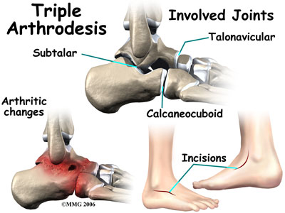 arthrodesis
