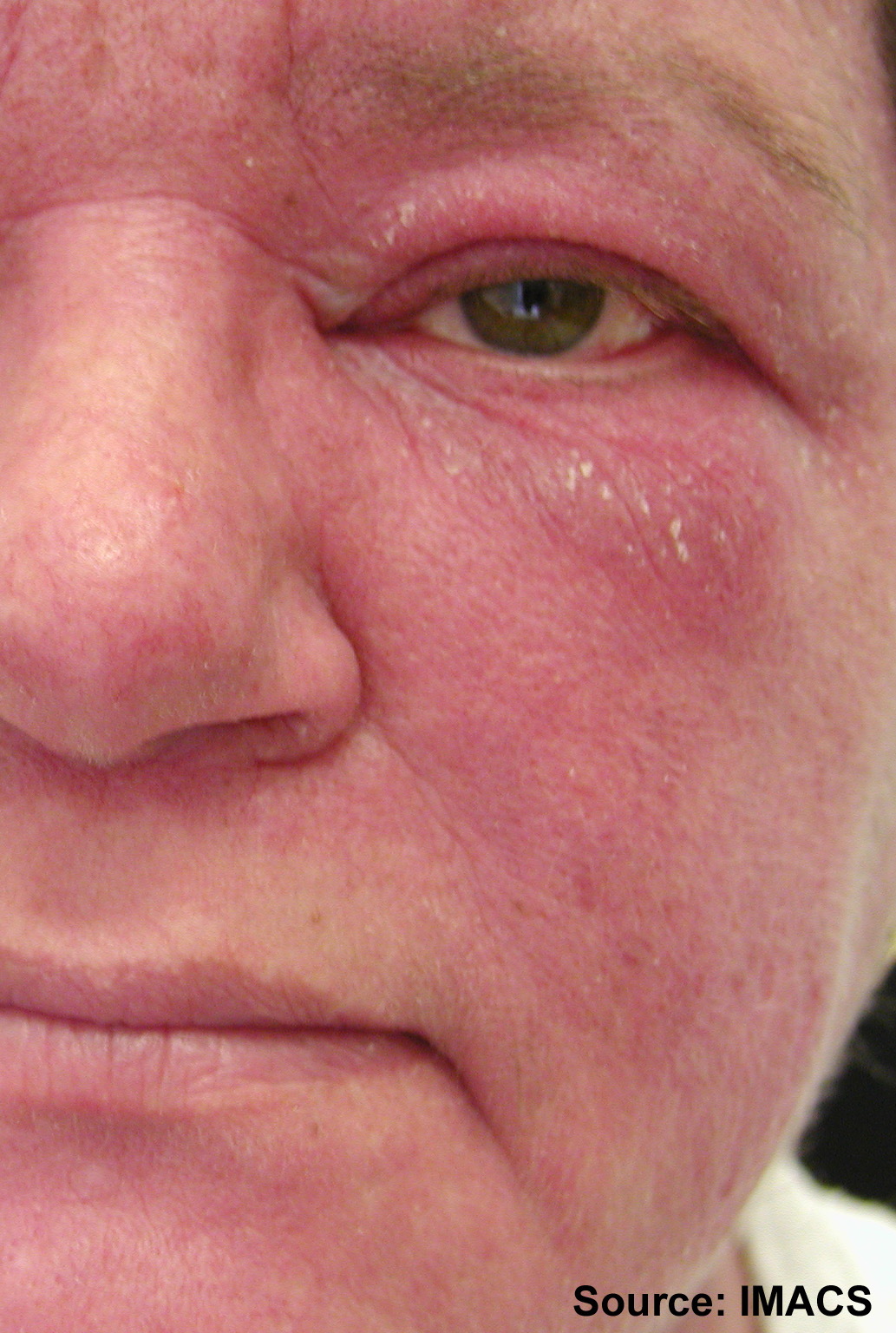 dermatomiozit2
