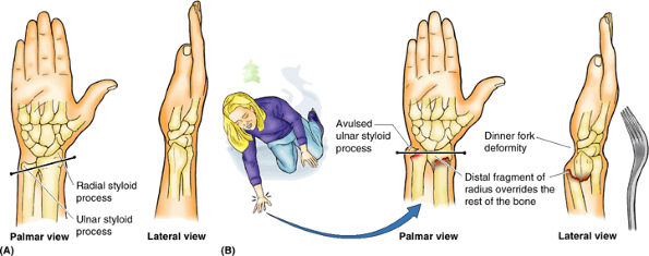 dinner_fork_deformity1327253168346