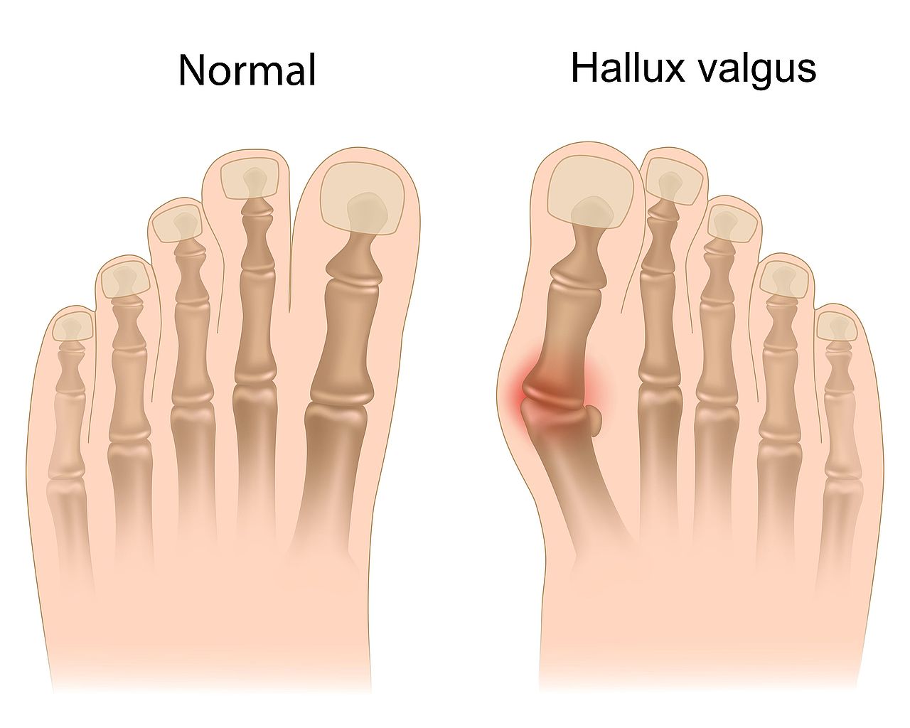 hallux-valgus-1280px-1024px0