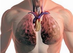 Дребноклетъчен белодробен карцином - лечение, химиотерапия с cyclophosphamide, радикална лобектомия със системна лимфна дисекция