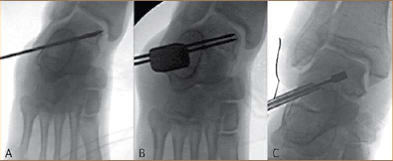 Лечение на деформираща артроза,Терапия на Osteochondrosis dissecans tali, дебридман на хрущялната част, размекване на хрущяла, Дисекиран фрагмент in situ, лечение на артроза, заболяване на костите