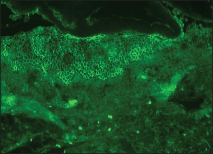 pemphigus