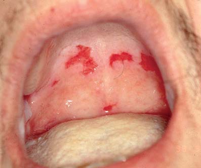 pemphigus_vulgar