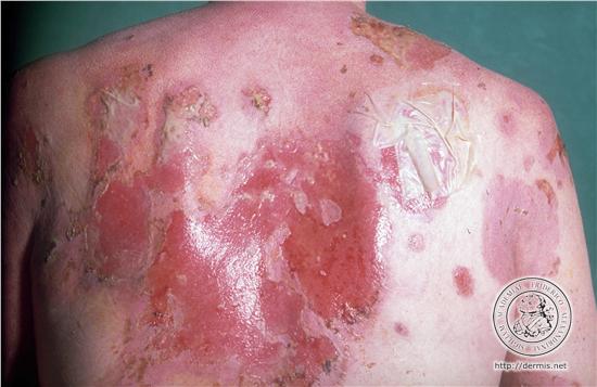 пемфигус вулгарис,автоимунно заболяване на кожата,autoimmune disorders,pemphigus vulgaris treatment, pemphigus vulgaris prognosis,симптомът на Никольский – свличане на епидермиса при натиск върху здрава кожа в близост до активни лезии,автоимунно заболяване на кожата и лигавиците, при което е нарушена връзката между кератиноцитите